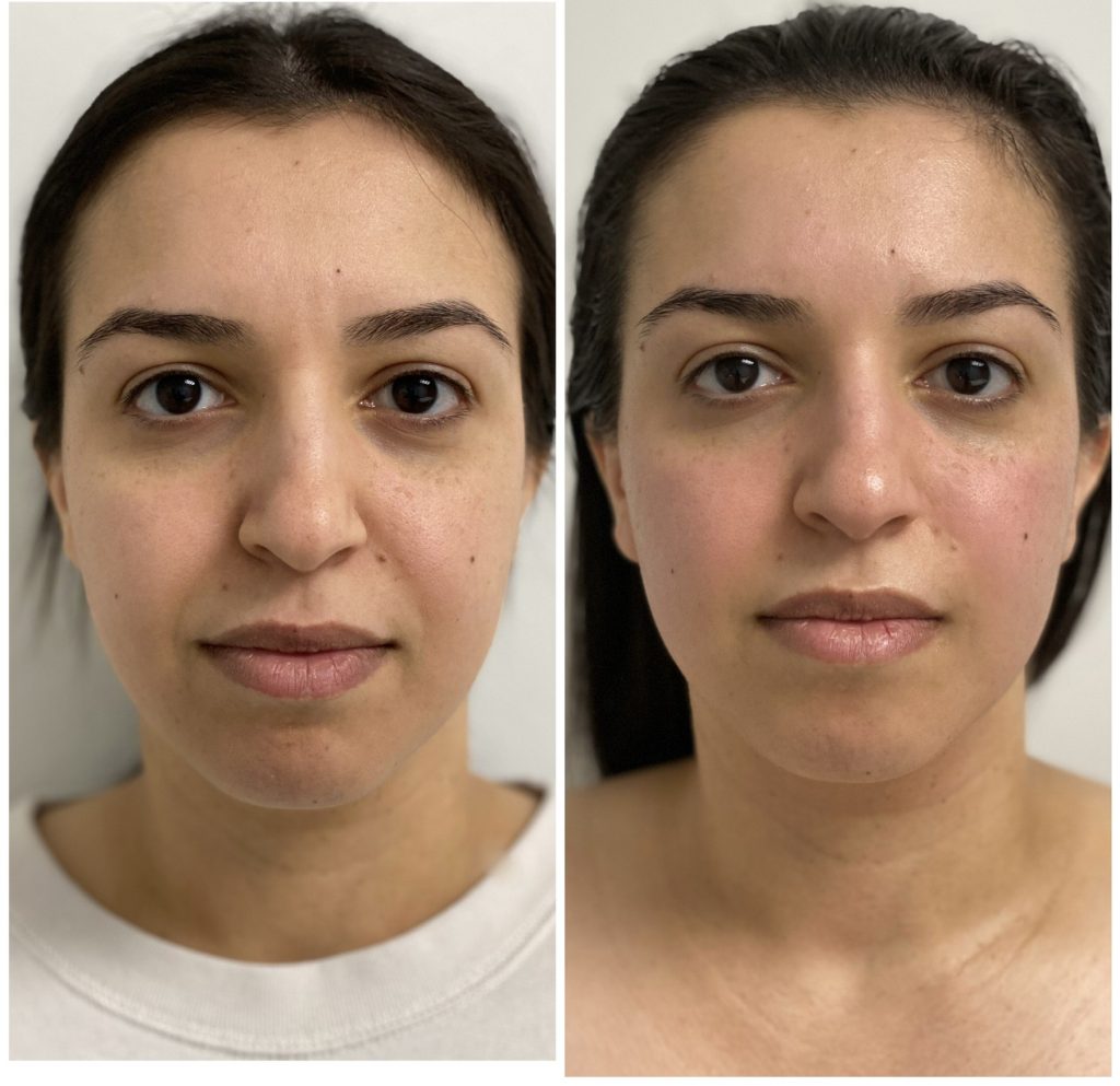 before after buccal massage from Via Skincare