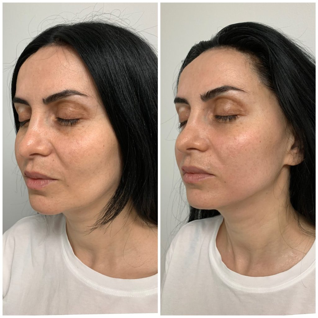 before after reconstructive massage from Via Skincare