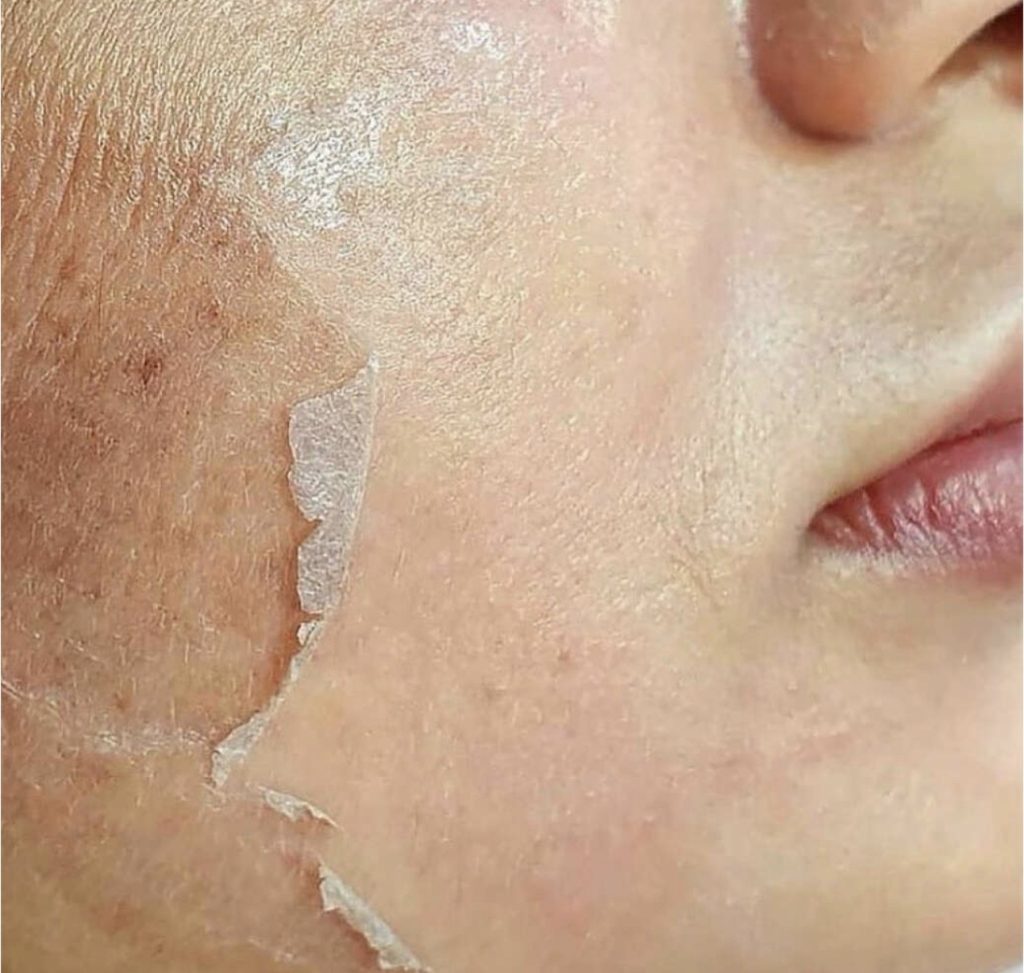 Close-up of a facial skincare treatment showing the cheek area of a person's skin with a partially peeled off face mask, highlighting the peeling process and skin texture.